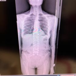 Payam Moazzaz, MD - My new spine and erector set after the surgery,
