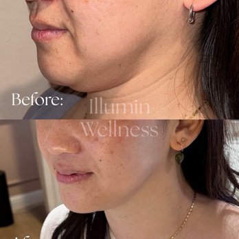 Illumin Wellness - Cryotherapy Near Me - Danville, California
