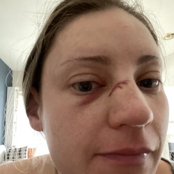 Valley ENT - Broken nose - Allergists Near Me - Scottsdale, Arizona Valley ENT - Broken nose - Allergists Near Me - Scottsdale, Arizona
