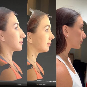 John Diaz, MD - Before/ Computerized preview/ 1 month later! - Cosmetic Surgeons Near Me - Beverly Hills, California