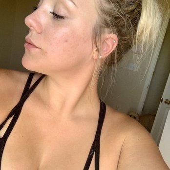 Green Valley Aesthetics - After laser genesis. - Skin Care Near Me - Las Vegas, Nevada