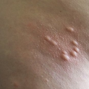 Ace Bedbug Exterminating NYC - Bed bug bites. - Pest Control Near Me - New York, New York