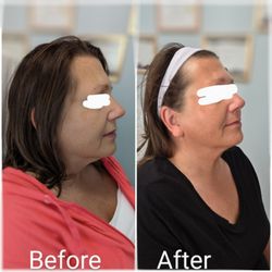 Lee Beauty Med Spa - Face lifting facial