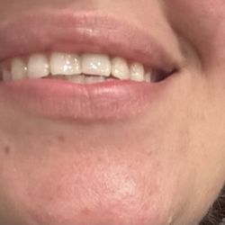 Victory Smiles - After ( temporary tooth )