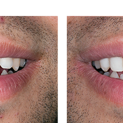 Atascadero Hills Dental - Before & After