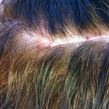 Shear Bella Salon - Scalp photos after service. - Hair Salons Near Me - Parker, Colorado Shear Bella Salon - Scalp photos after service. - Hair Salons Near Me - Parker, Colorado