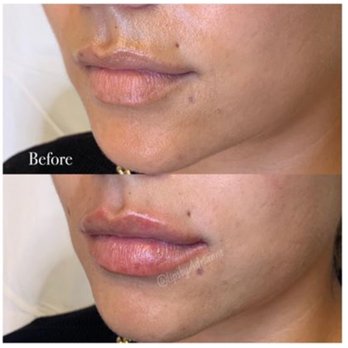 Encore Medspa - 0.5ml of Restylane Refyne lifts and contours the Cupid's bow. - Laser Hair Removal Near Me - Walnut Creek, California