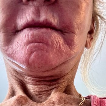 Boston Facial Plastic Surgery - Before - Cosmetic Surgeons Near Me - Quincy, Massachusetts