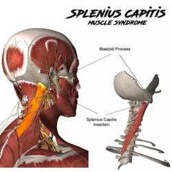 State 48 Massage - Headaches or neck tension? Your Splenius Capitis might be the culprit -- state 48 massage can fix it.