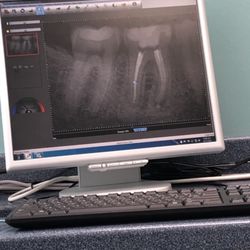 Beaches Endodontics - My first root canal