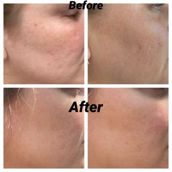Skinsational Aesthetics - First photo is before, after is after 2 microneedling treatments. - Skin Care Near Me - Denver, North Carolina Skinsational Aesthetics - First photo is before, after is after 2 microneedling treatments. - Skin Care Near Me - Denver, North Carolina