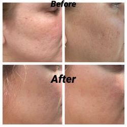 Skinsational Aesthetics - First photo is before, after is after 2 microneedling treatments.