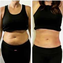 Olive Medical Aesthetics - Inmode Procedure + Fat Dissolve Injection