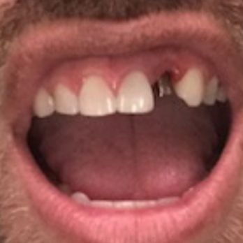 Gary J Wokuluk, DDS - Here is the metal abutment I had put in against my wishes. My insurance covers a white abutment, I asked for a white abutment. - General Dentistry Near Me - El Cajon, California Gary J Wokuluk, DDS - Here is the metal abutment I had put in against my wishes. My insurance covers a white abutment, I asked for a white abutment. - General Dentistry Near Me - El Cajon, California
