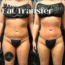 Illuminae Contour + Detox - Post fat transfer