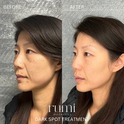Rumi Aesthetics - Hyperpigmentation Skin Treatment and Facial Balancing