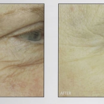 Dubow Dermatology - Dermatologist Dr Dubow is an expert with Fraxel Repair fractional resurfacing. - Dermatologists Near Me - Beverly Hills, California Dubow Dermatology - Dermatologist Dr Dubow is an expert with Fraxel Repair fractional resurfacing. - Dermatologists Near Me - Beverly Hills, California