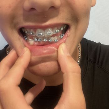 Kenneth Gurstein, DDS - This is right when he got the bottom braces added - Orthodontists Near Me - Woodland Hills, California Kenneth Gurstein, DDS - This is right when he got the bottom braces added - Orthodontists Near Me - Woodland Hills, California