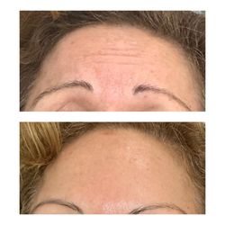 Emerald Med Spa - Botox