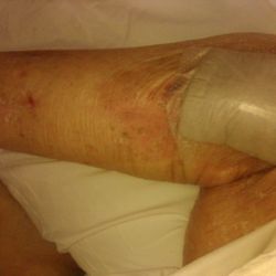 CareOne at Valley - Picture of mother's knee, leg from lack if attention at Care One Valley