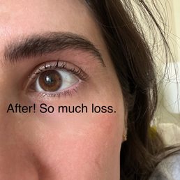 Lash loss due to over processing my lashes Lash loss due to over processing my lashes
