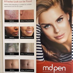 Danielle's Beauty Spa - MTS treatment for Acne / big pore/stretch marks