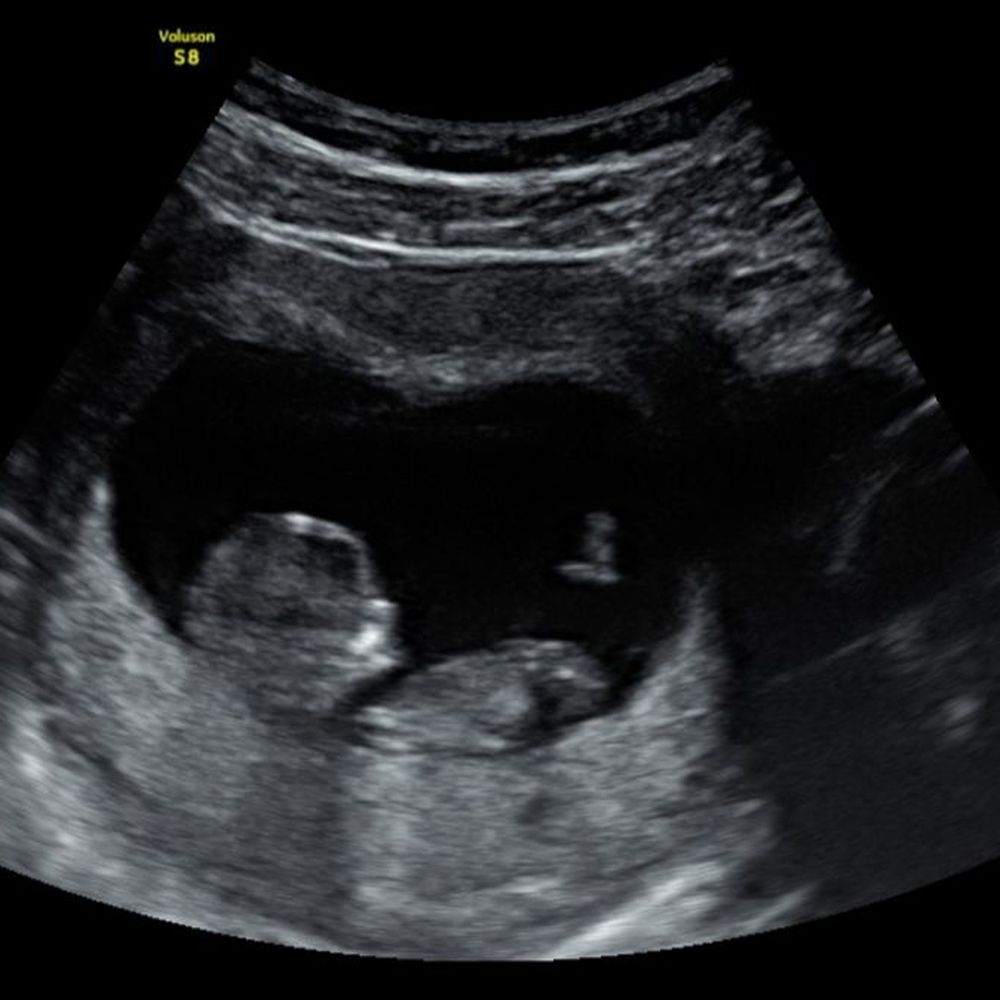 Sacramento Imaging - 11 weeks! - Diagnostic Imaging Near Me - Rancho Cordova, California Sacramento Imaging - 11 weeks! - Diagnostic Imaging Near Me - Rancho Cordova, California