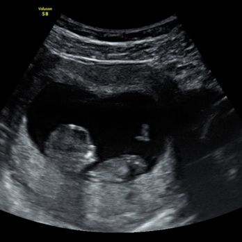 Sacramento Imaging - 11 weeks! - Diagnostic Imaging Near Me - Rancho Cordova, California Sacramento Imaging - 11 weeks! - Diagnostic Imaging Near Me - Rancho Cordova, California