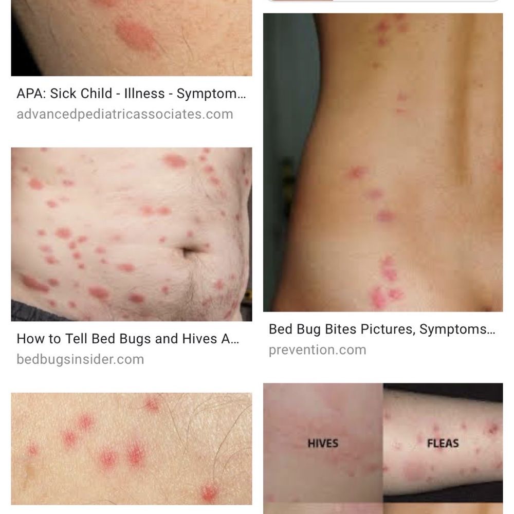 These are googled pictures of bed bug bites so you can see what they look like These are googled pictures of bed bug bites so you can see what they look like