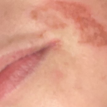 Meadow's Nails Spa - Upper lip burned from waxing - Nail Salons Near Me - Stafford, Texas