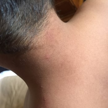 Grand Inn - Went from his shoulder up his neck. Similar to bedbug bites I saw on Google.. Pic was taken after some of the swelling went down.. - Hotels Near Me - Fullerton, California Grand Inn - Went from his shoulder up his neck. Similar to bedbug bites I saw on Google.. Pic was taken after some of the swelling went down.. - Hotels Near Me - Fullerton, California