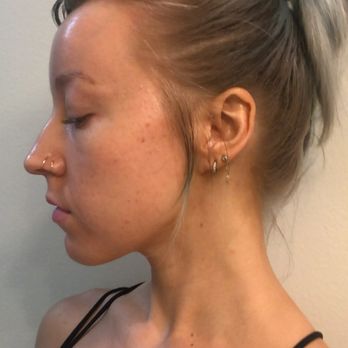 Clear Skin Solutions - After - Acne Treatment Near Me - Alhambra, California