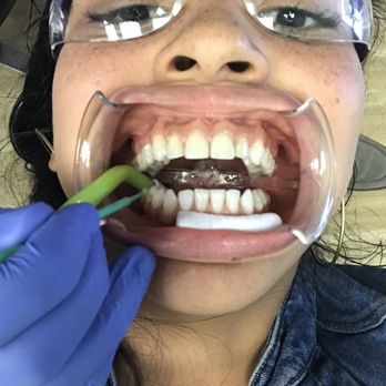 Modern Orthodontics - Getting my attachment on for my Invisalign! - Orthodontists Near Me - Bristow, Virginia Modern Orthodontics - Getting my attachment on for my Invisalign! - Orthodontists Near Me - Bristow, Virginia