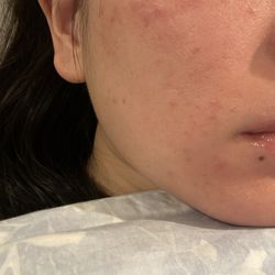 Aesthetica Cosmetic & Laser Center - Break out