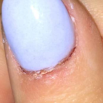 Castle Nail Spa - One of the six infected nails from my visit on 8/9/2015. - Nail Salons Near Me - Plano, Texas Castle Nail Spa - One of the six infected nails from my visit on 8/9/2015. - Nail Salons Near Me - Plano, Texas