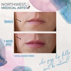 Northwest Medical Arts - Natural lip filler