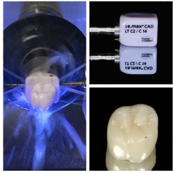Kingwood Family & Cosmetic Dentistry - Same day crowns!! No need for temporary crowns.
