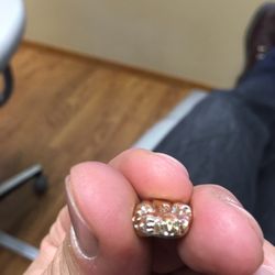 North Tahoe Dental - Custom gold tooth Dr. Fligor did when I needed to get a bad tooth replaced