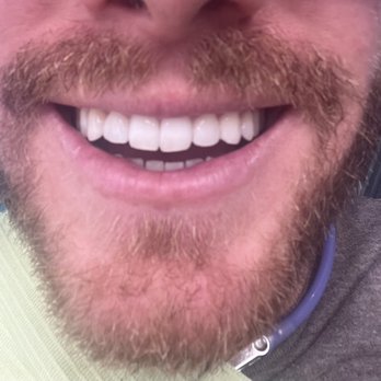 Enclave Dental - After - Pediatric Dentists Near Me - Southlake, Texas Enclave Dental - After - Pediatric Dentists Near Me - Southlake, Texas