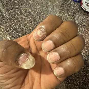 Sweet Nails - My damaged nails with rash around cuticles of all fingers. - Hair Salons Near Me - Brooklyn, New York