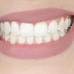 Capital Springs Orthodontics - Perfect smile, Dr. Moody was able to fix my chipped tooth after my Invisalign was complete