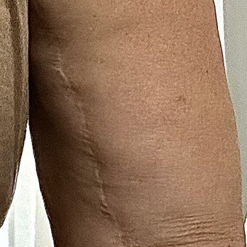 Wright Surgical Arts - Wrinkly scar - Medical Spas Near Me - Pasco, Washington Wright Surgical Arts - Wrinkly scar - Medical Spas Near Me - Pasco, Washington