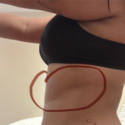 Mia Aesthetics - Side of dent