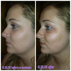 Essential Esthetics - Before and after of my first visit!