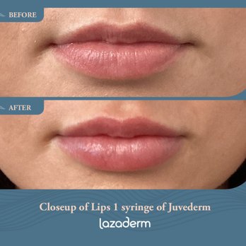 Lazaderm - Before & After of Lip Filler - Skin Care Near Me - Sioux Falls, South Dakota