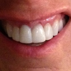 Sleep Healthy PA - The thickness and amount the four front teeth protruded was not natural. Never came anywhere close to looking like real teeth, traumatized