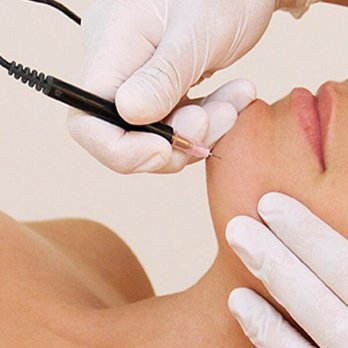 Ideal Electrolysis - Hair Removal Near Me - Laguna Niguel, California Ideal Electrolysis - Hair Removal Near Me - Laguna Niguel, California
