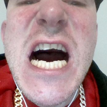 A & A Dental Centre - need the chipped tooth worked on. - General Dentistry Near Me - Vancouver, British Columbia A & A Dental Centre - need the chipped tooth worked on. - General Dentistry Near Me - Vancouver, British Columbia