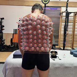 Radiance Fitness - Cupping