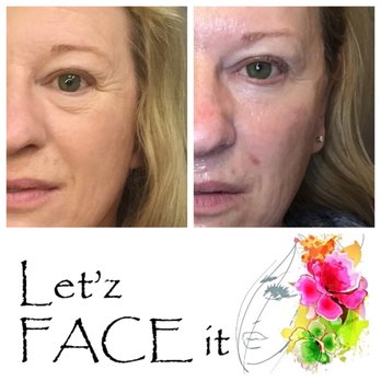 Let'z Face It - INCREDIBLE improvement in upper & lower eye laxity, as well as overall skin texture/tone (after 2 VIVACE RF microneedling treatments) - Medical Spas Near Me - Chandler, Arizona Let'z Face It - INCREDIBLE improvement in upper & lower eye laxity, as well as overall skin texture/tone (after 2 VIVACE RF microneedling treatments) - Medical Spas Near Me - Chandler, Arizona